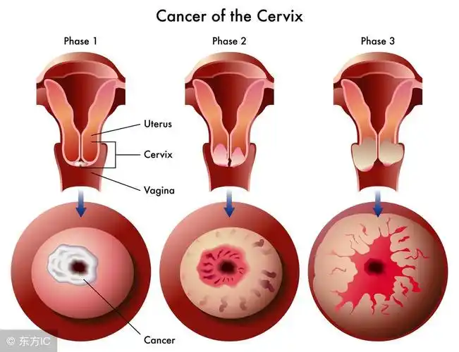子宫囊肿严重吗子宫囊会引起哪些病变