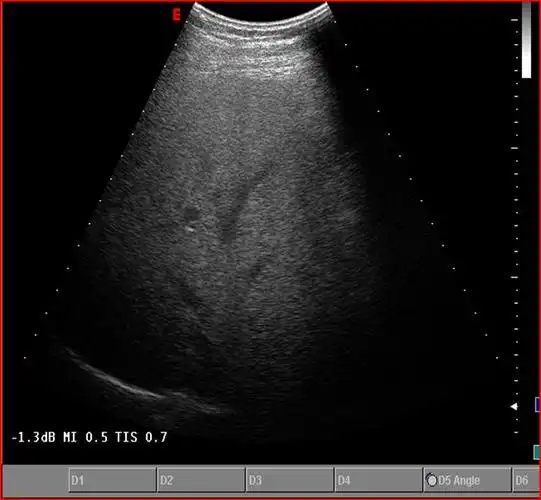 肝脏超声脂肪肝