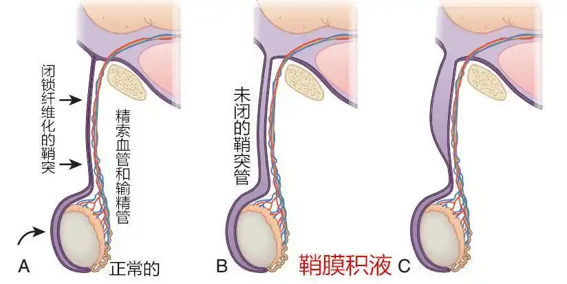 看懂儿童腹股沟疝与鞘膜积液