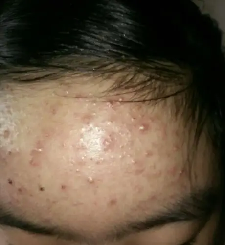 12岁女孩额头长了好多痘痘,哪家医院可以治疗?求推荐