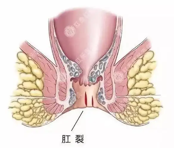 肛裂的治疗及术后护理