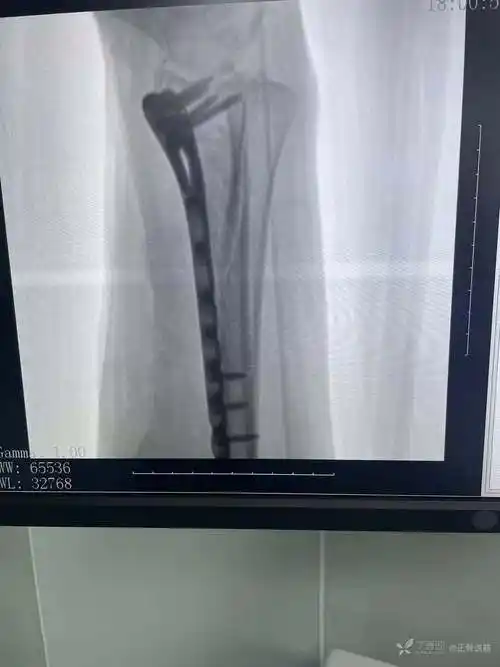 右桡骨远端粉碎性骨折手术一例