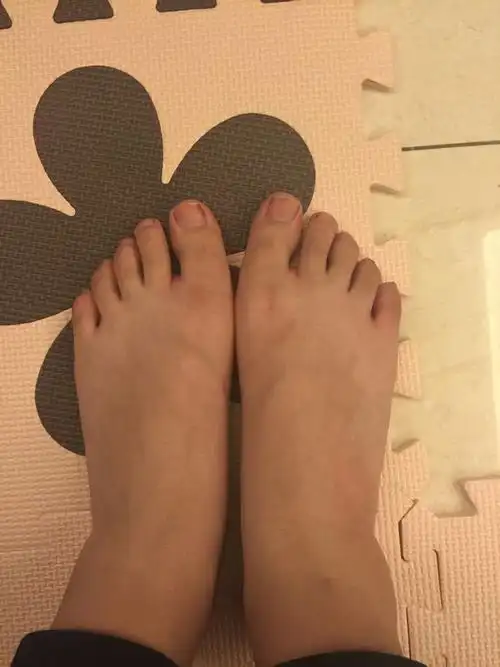 我脚指甲是歪的 特别大脚趾 从小就这样 现在16岁 算什么情况?