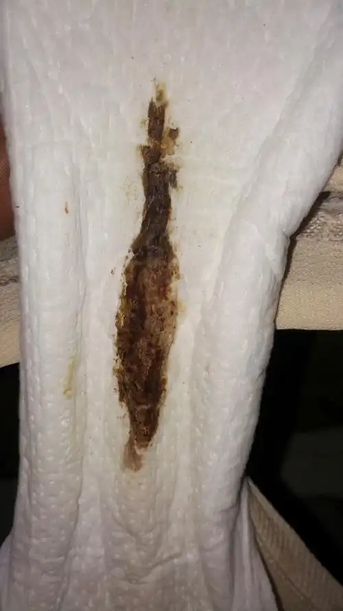 继而有轻微的腰酸腹胀,或阴道有少许出血者,均为先兆流产的征象属于