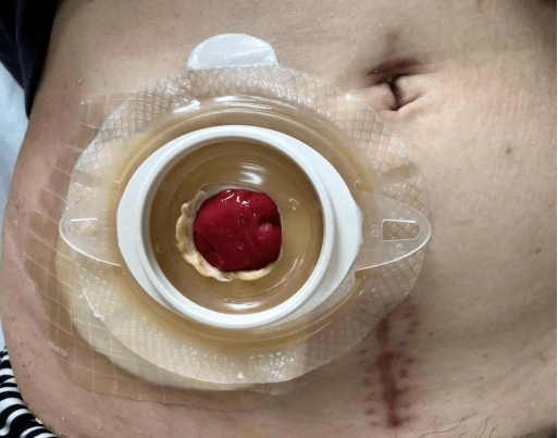 肠造口患者节假日发生排泄物渗漏,如何处理?