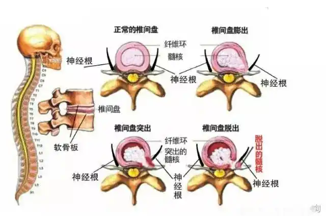 腰椎间盘膨出和突出有什么区别?