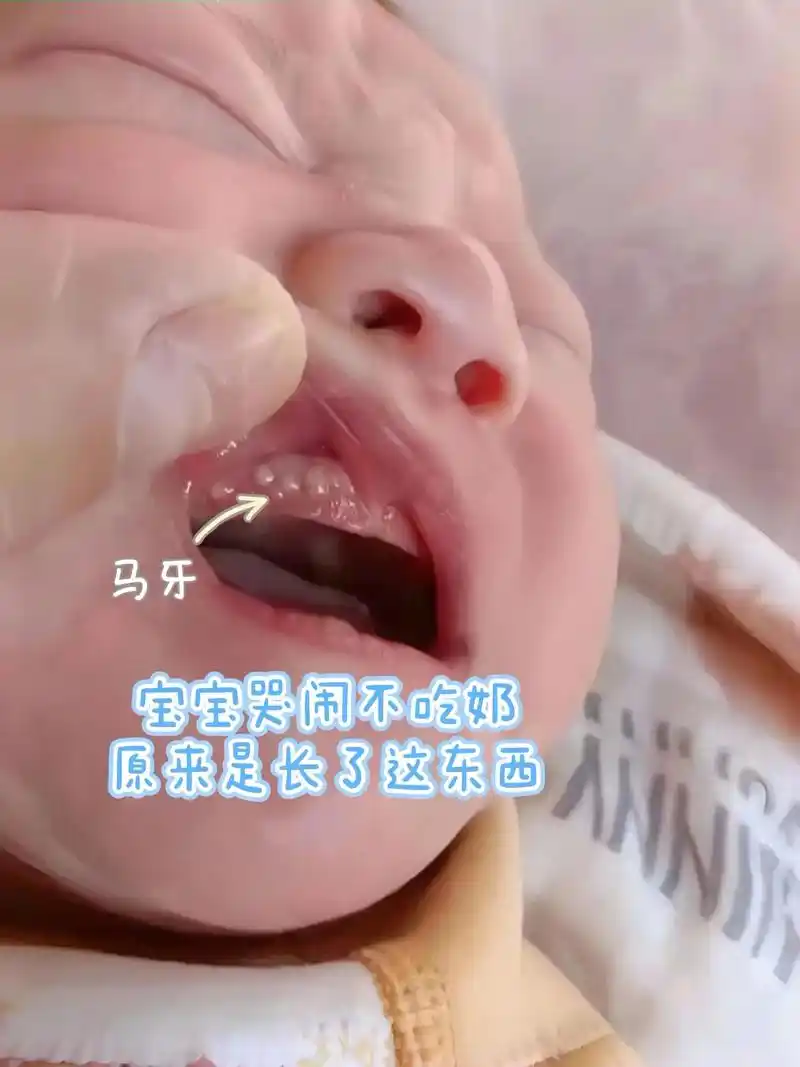 马牙,也称"板牙",医学上叫做"上皮珠"