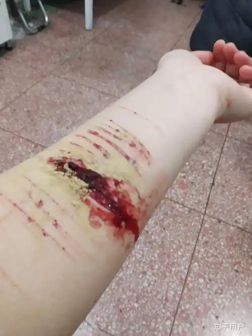 你为什么不再自残了? - 知乎
