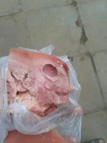 脂肪瘤买什么保险 脂肪瘤保险会拒保吗