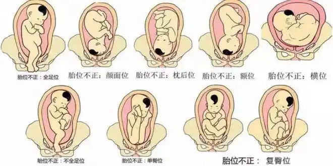 胎儿先露的指定部位与母体骨盆前,后,左,右的关系,正常胎位多为枕前位