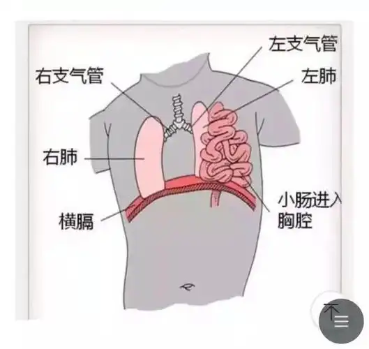 先天性膈疝我们能做的事
