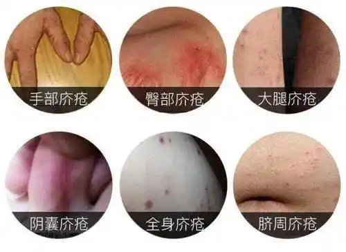 疥疮到了冬季瘙痒加重是因为疥疮结节里面有疥虫吗