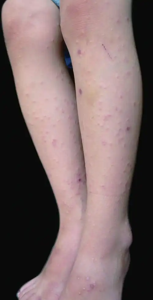 儿童丘疹性肢端皮炎图片 儿童丘疹性肢端皮炎症状图 儿童丘疹性肢端