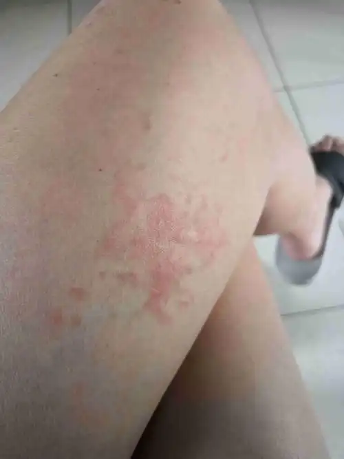 前几天腿上起了一片红的 有点痒