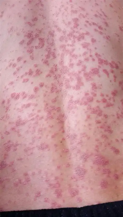 艾滋病有什么明显症状_艾滋病症状_艾滋病咨询检测网