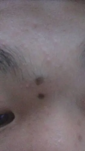 我脸上有颗肉痣,该怎么祛除它?