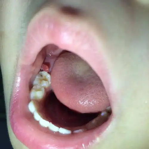 六岁男童 今天发现牙齿左边长了这个东西 软软的 他自己不痛 昨天还没