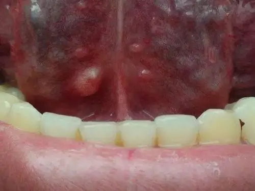 千万别忽视身体这部位的"小疙瘩" 警惕癌变!_肿块