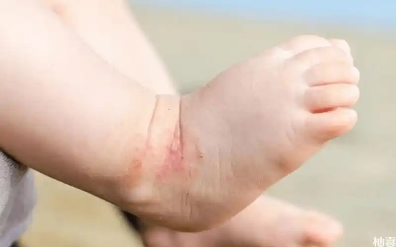 儿童尿布疹湿疹红屁股别弄混淆症状治疗区别大