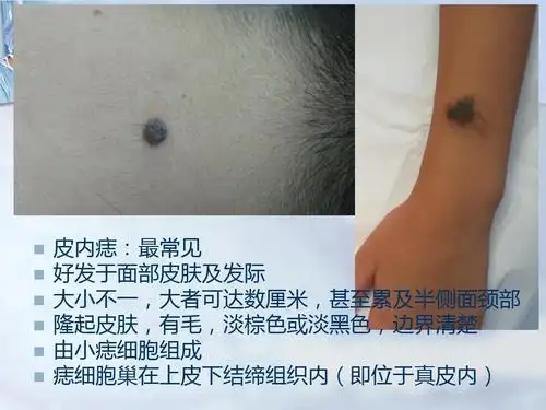 人文社科 设计/艺术 谈黑色变--认识色素痣与黑素瘤ppt 皮内痣:最常见