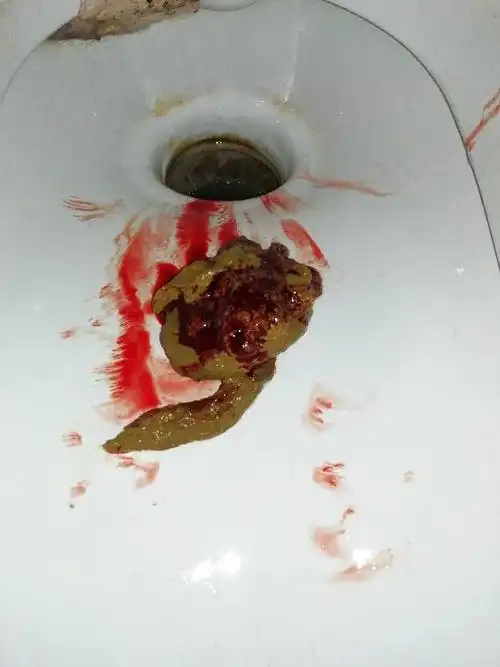 大便有血好几年是痔疮吗