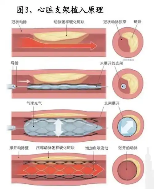 心脏支架植入原理
