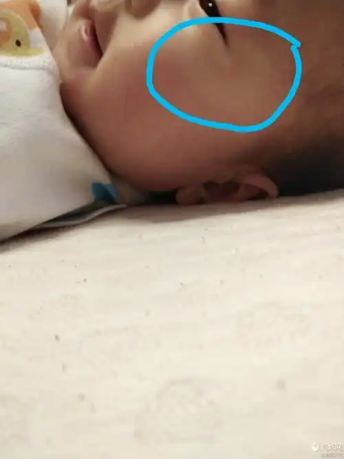 4个月宝宝眼角皮肤比其他地方皮肤白是怎么回事呢