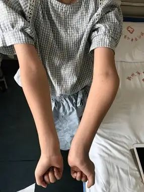 被称为肘内翻畸形而人体肘关节提携角小于0度此角度被称为提携角女性