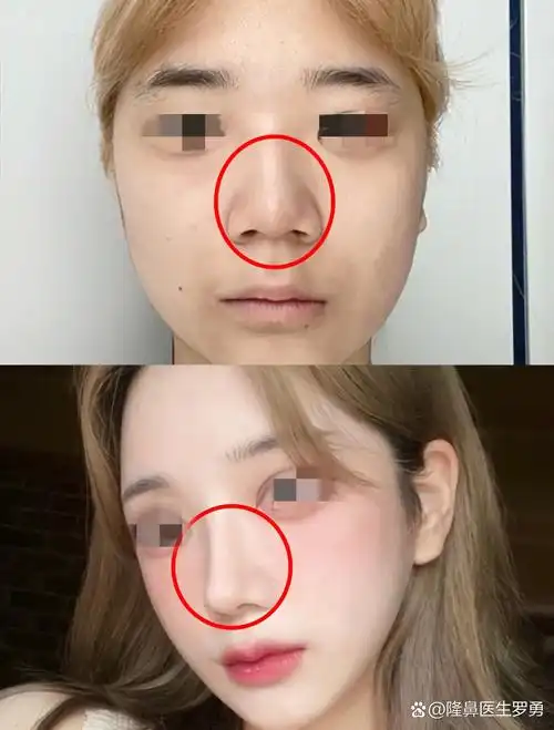 山根低平,鼻头肥大,鼻翼宽厚,显得面中十分扁平,她告诉我们想要精致