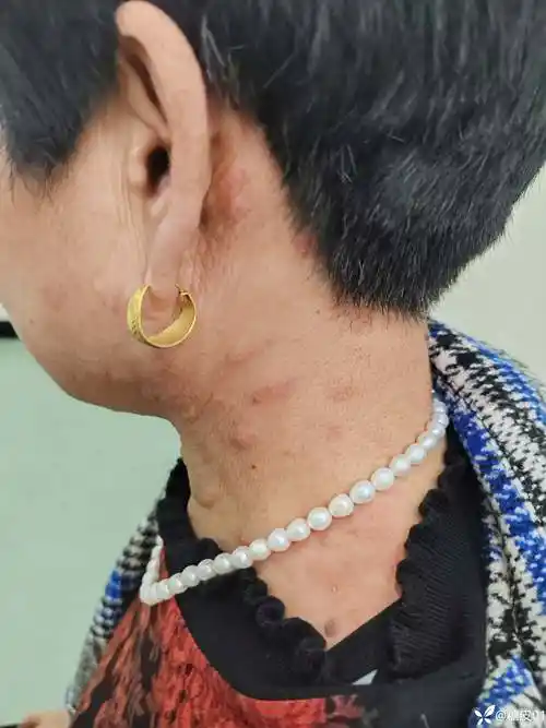 颈部皮疹一例