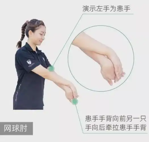 2个自检方式3个牵伸动作网球肘的最佳治疗方法