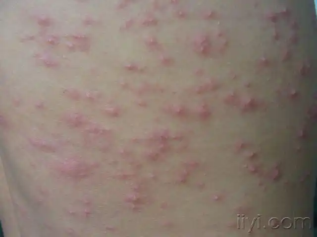 看看是什么病——周身红斑丘疱疹 - 皮肤及性传播