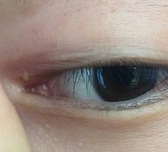 问:眼角一粒肉球,左边那