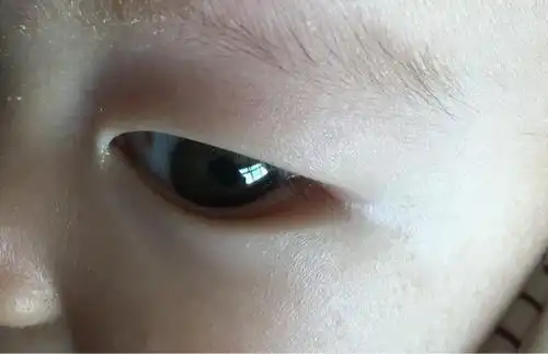 宝宝眼睛这是怎么了