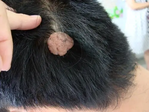 典型病例——软纤维瘤 - 皮肤及性传播疾病讨论版 - 爱爱医医学论坛