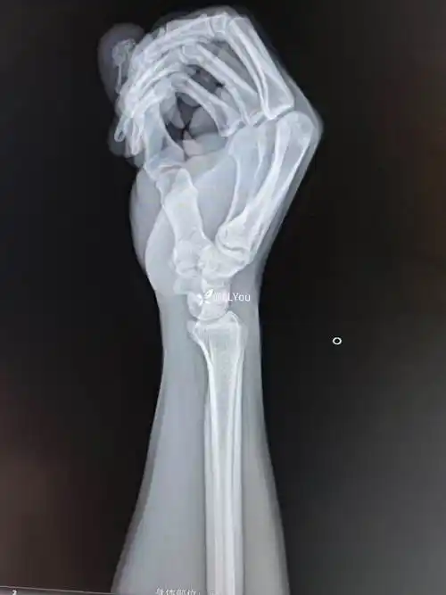 2408普放 | 看这例腕外伤x光片是体位有问题还是损伤有了改变?