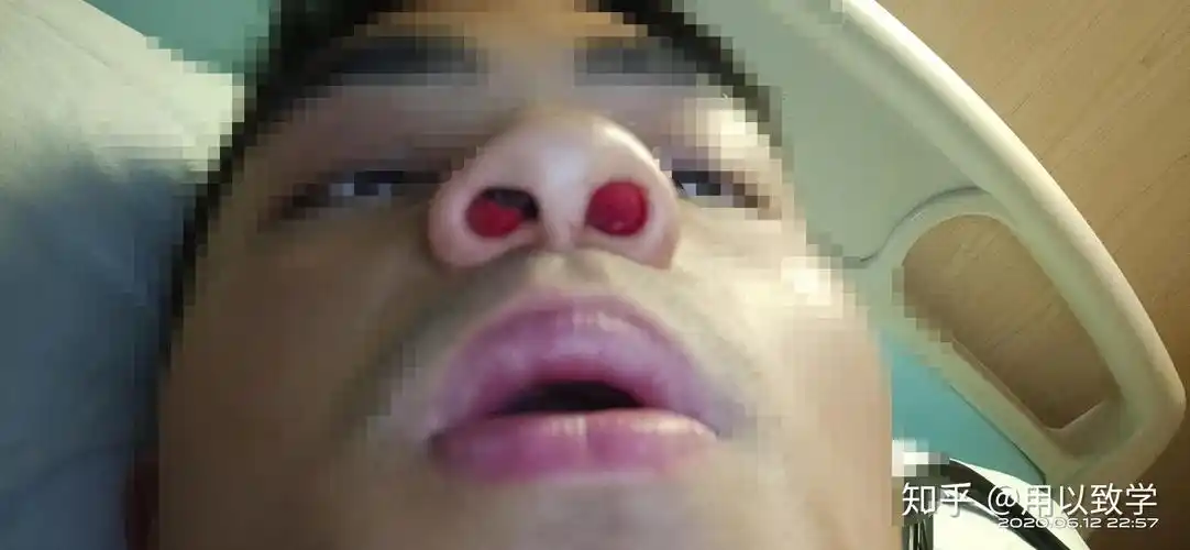 鼻中隔偏曲鼻甲肥大翼管神经切除手术