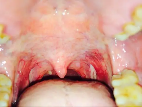 我咽喉部有白色是什么原因