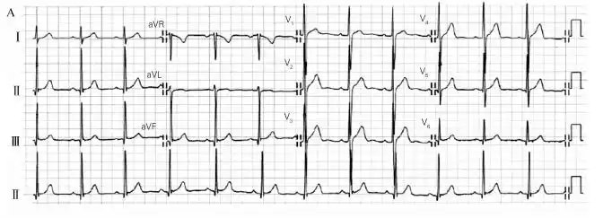 右室肥厚心电图诊断新视点