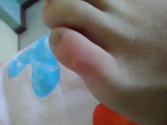 小脚趾外侧有个硬硬的突起,不碰不疼,一穿窄的高跟鞋就疼,请教一下这