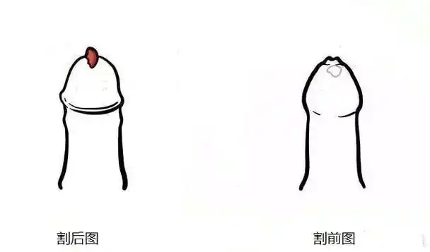 包茎割前割后图