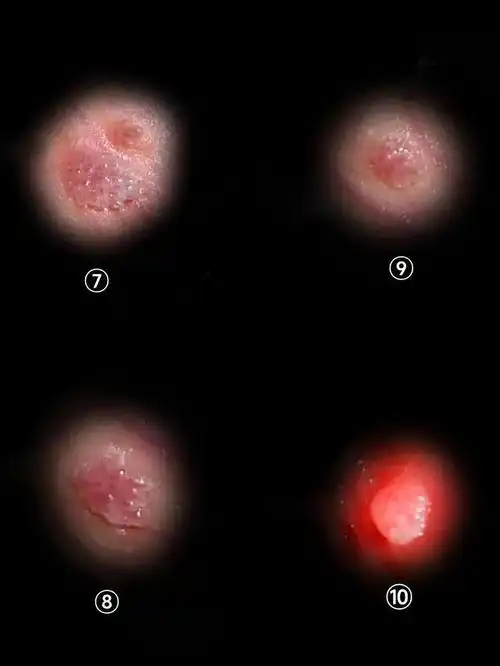 只需3点,轻松判断是否感染!|性病|乳头|症状|肛周|生殖器_网易订阅