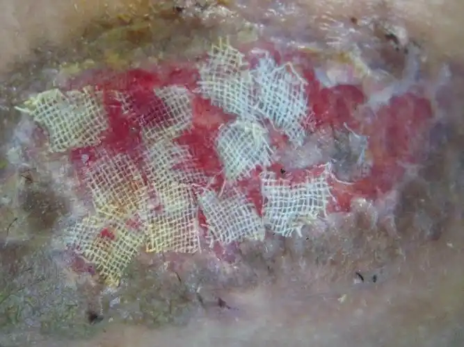 目前合适植皮吗(腋臭高频电离子治疗后伤口感染坏死)