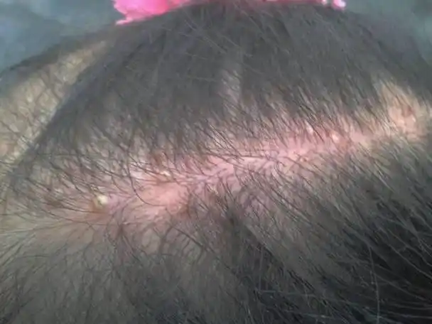 毛囊炎|头皮|痘痘_新浪新闻