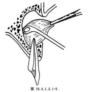 口内途径颌骨囊肿摘除术手术过程_百姓健康网