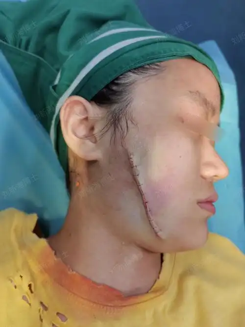 胎记患者,一次性切除,减张内缝合术,术后可以减轻疤痕的痕迹