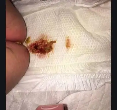 宝宝痔疮初期图片 (15)_有来医生