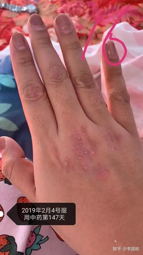 手背治疗效果图片(下)