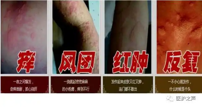 急性荨麻疹 突然发病,基本皮疹为风团,苍白色或红色,周围有红晕,边界