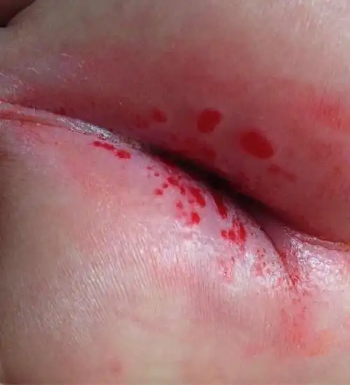 两元钱解决宝宝红屁股